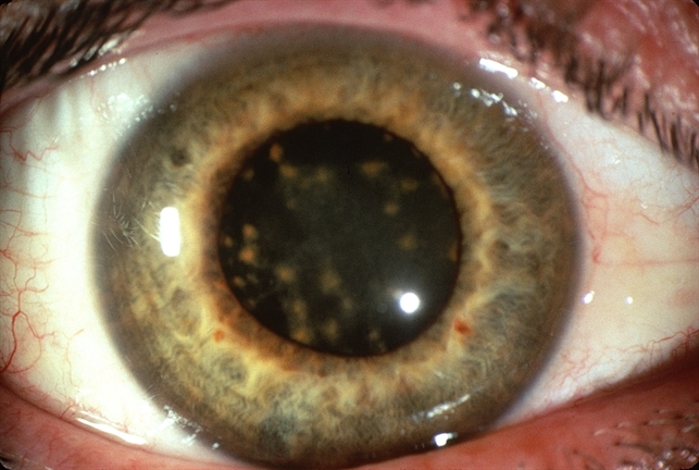 Siderosis Retina Image Bank